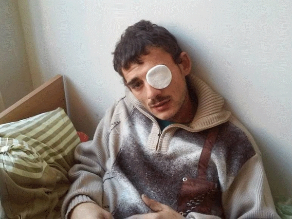 Батько двох дітей, 23-річний Павло Сурмай майже осліп на ліве око – позитивних прогнозів лікарі поки не дають. 
Фото: Фейсбук Мирослава Горвата